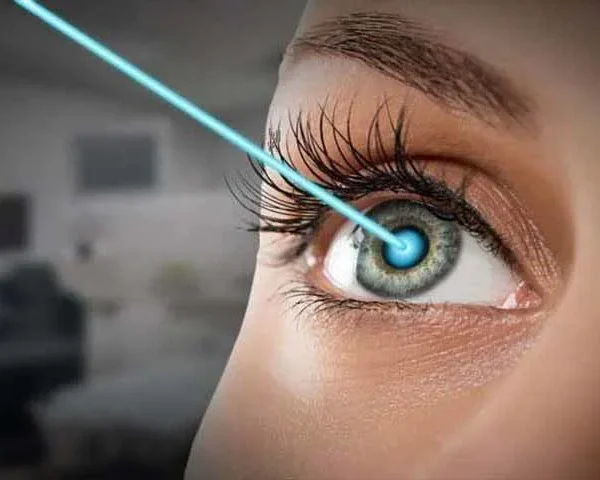 تصحيح النظر بالليزك