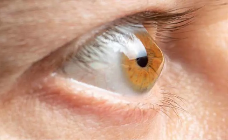 القرنية المخروطية