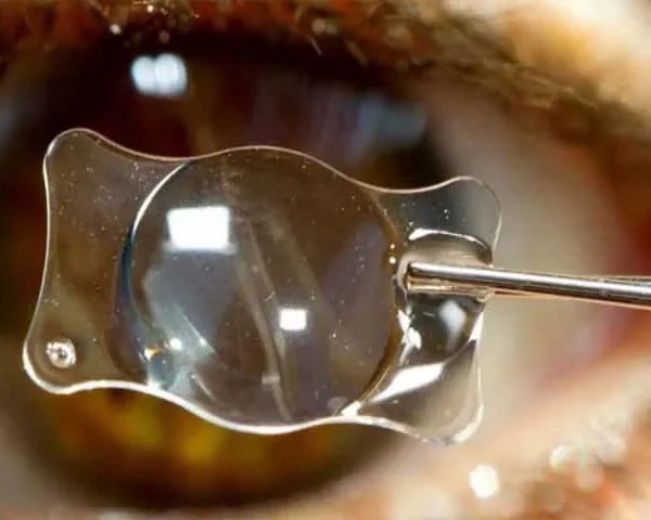 زراعة عدسات تقنية زراعة العدسات