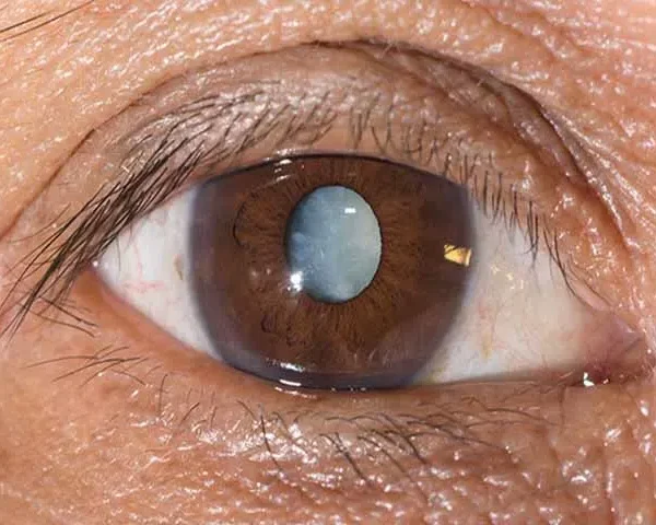 الماء الأبيض أعراض الماء الأبيض